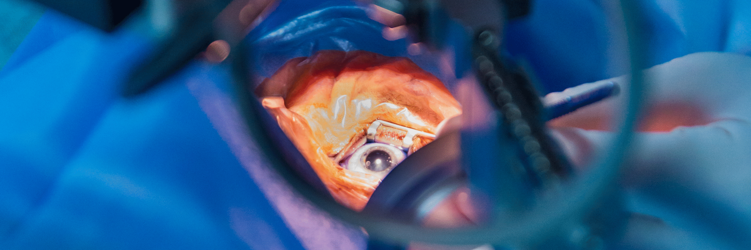 Why Monal Hospital is a Trusted Name for Cataract Treatment in Vadodara